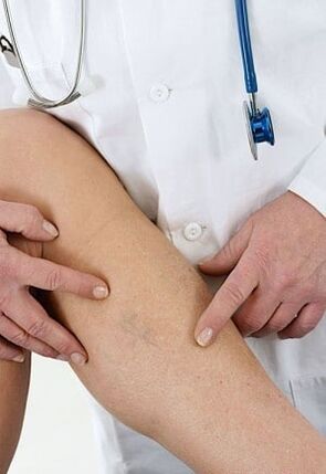 Alt ekstremitelerin varisli damarları