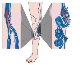 Nedenleri, belirtileri