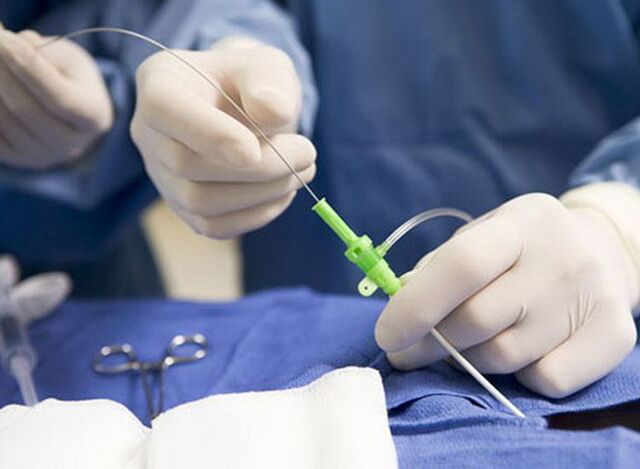 Radyofrekans ablasyonu