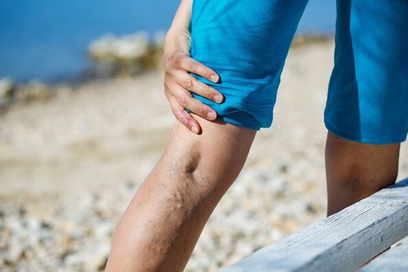 Bacaklarda varisli damarlarla birlikte rahatsız edici ağrı